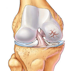 Osteoarthritis